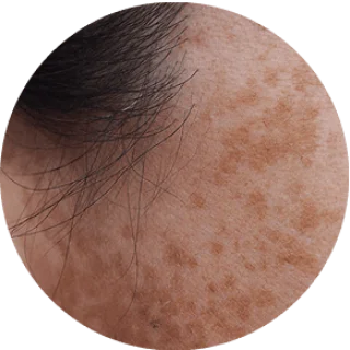 DARK SPOTS