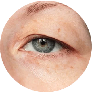 DROOPY EYELIDS