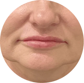 SAGGING JAWLINE