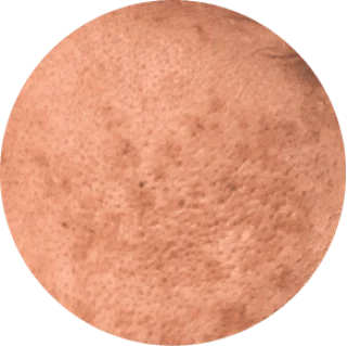SUN DAMAGE