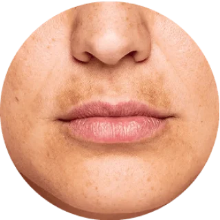 UNEVEN SKIN TONE